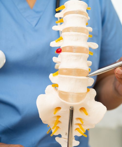 Doctor with lumbar vertebra bone skeleton and nerve model for treatment in the orthopedic department.